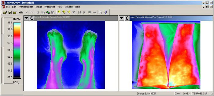 ThermArray images of lower extremities